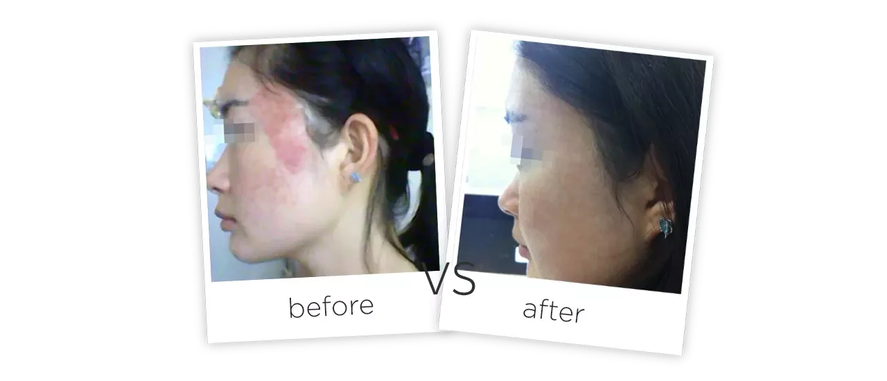 Co2 Láser Fraccional Multi-Función Antes y despues