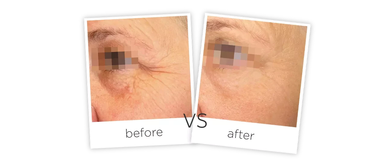 máquina HIFU Tratamiento Antes y despues