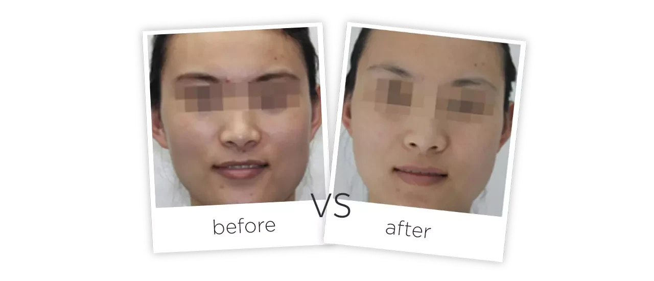 Rejuvenecimiento Facial con SHR Antes y Después