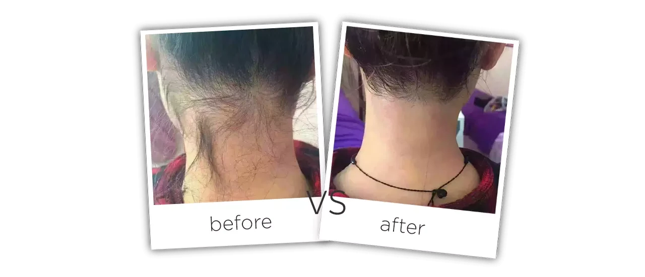 Máquina de láser depilación Antes y despues