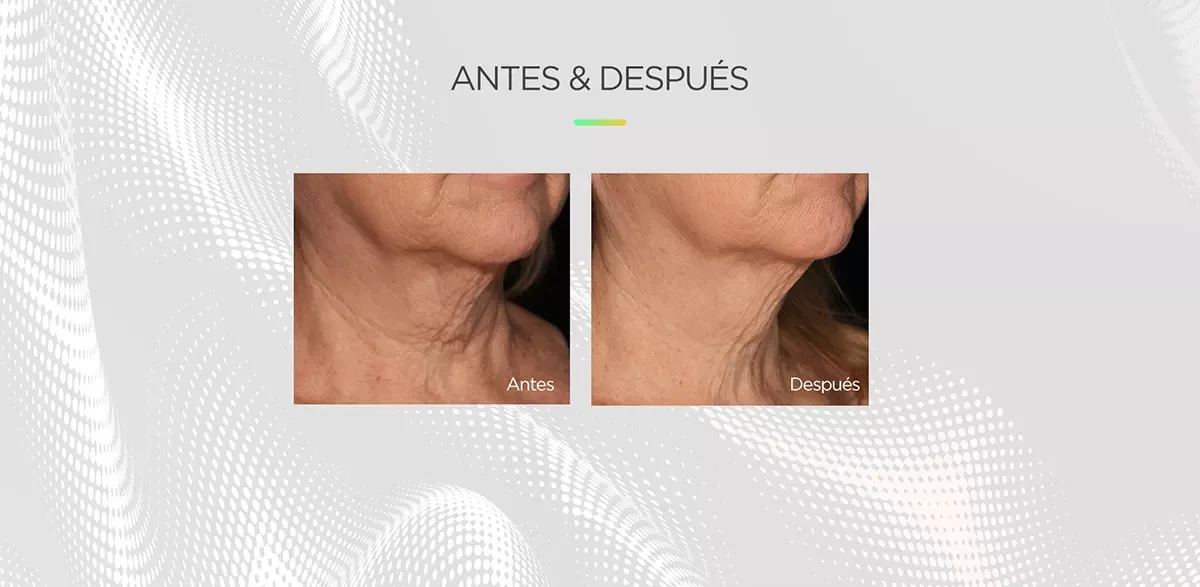 La Máquina HIFU de Belleza Para Antiedad